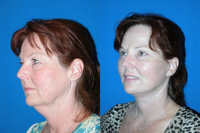 Facelift before and after photo