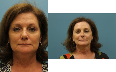 Brow Lift before and after photo