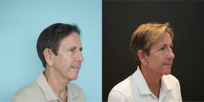 Brow Lift before and after photo
