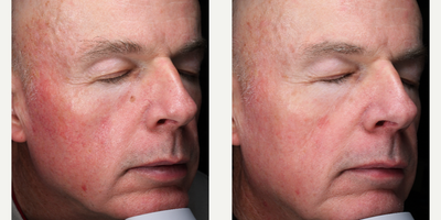 Excel V before and after photo