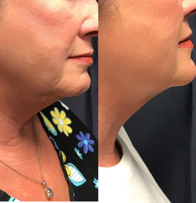 Kybella before and after photo