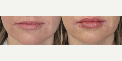 Lip Fillers before and after photo