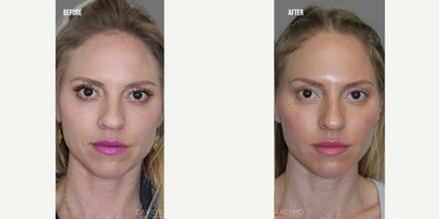 Lip Fillers before and after photo
