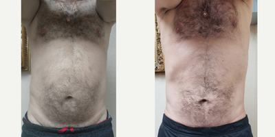Vaser Liposuction before and after photo