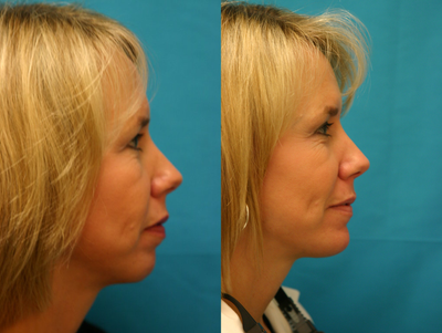 Chin Implant before and after photo