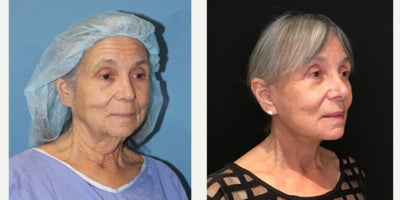 CO2 Laser before and after photo