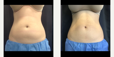 CoolSculpting before and after photo