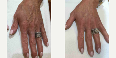 Dermal Fillers before and after photo