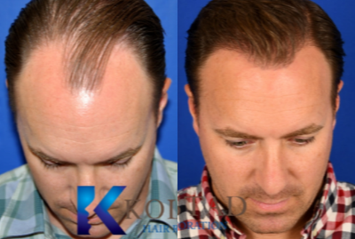 Hair Transplant before and after photo