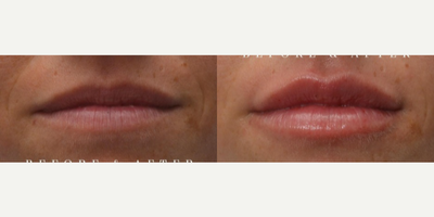 Lip Fillers before and after photo