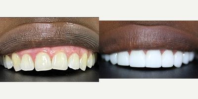 Porcelain Veneers before and after photo
