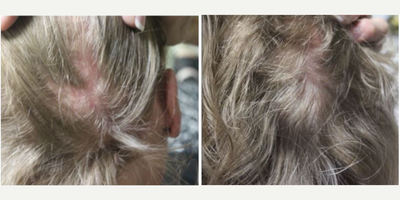 PRP for Hair Loss before and after photo