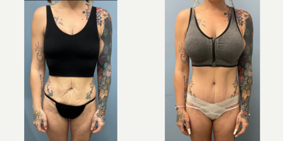 Tummy Tuck before and after photo