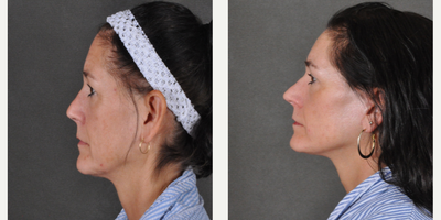 Facelift before and after photo