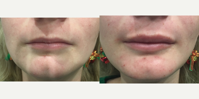Juvederm before and after photo