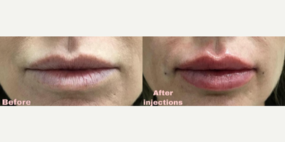 Juvederm before and after photo