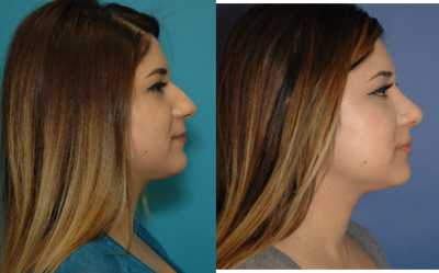 Rhinoplasty before and after photo