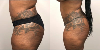 Tummy Tuck Revision before and after photo