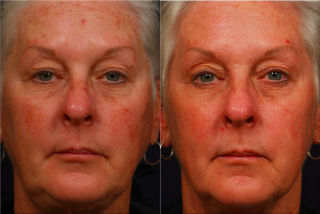 Vbeam before and after photo