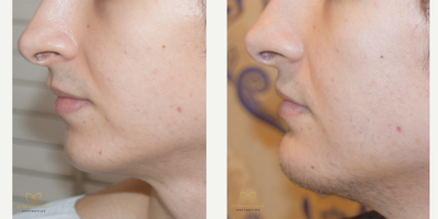 Chin Implant before and after photo