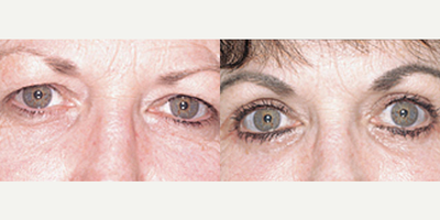 Eyelid Surgery before and after photo