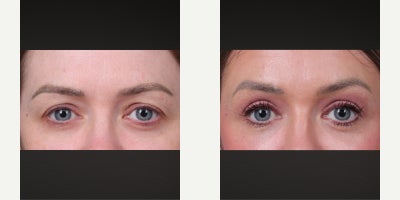 Eyelid Surgery before and after photo