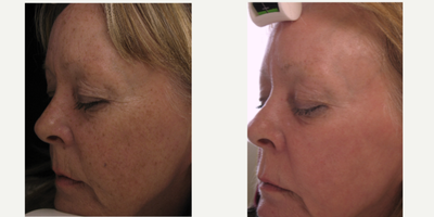 IPL before and after photo
