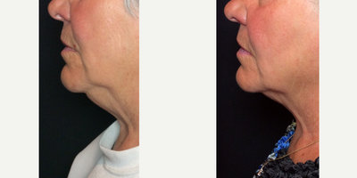 Kybella before and after photo