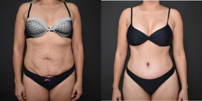 Mommy Makeover before and after photo