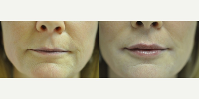 Restylane before and after photo