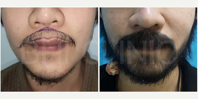 Beard Transplant before and after photo
