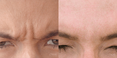 Botox before and after photo