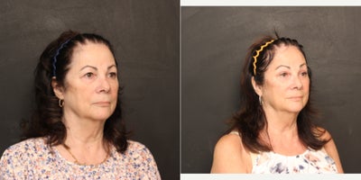 Brow Lift before and after photo