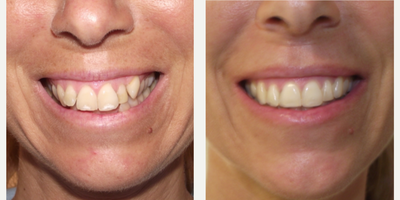 Damon Braces before and after photo