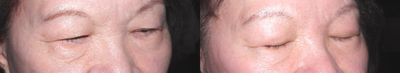 Eyelid Surgery before and after photo