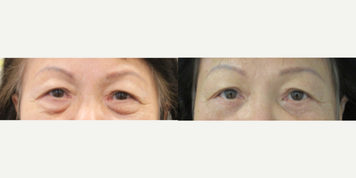 Eyelid Surgery before and after photo
