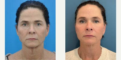 Brow Lift before and after photo