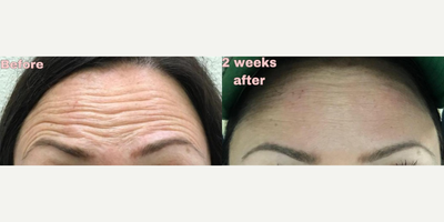 Dysport before and after photo