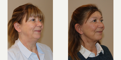 Facelift before and after photo