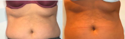 Kybella before and after photo