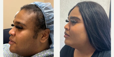 Lip Lift before and after photo