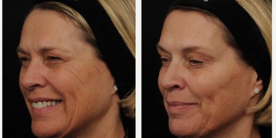 Botox before and after photo