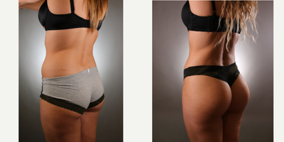 Brazilian Butt Lift before and after photo