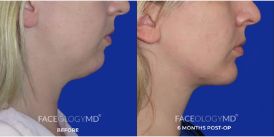 Chin Liposuction before and after photo