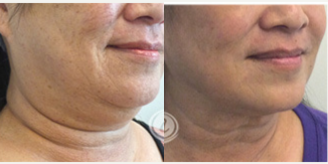 CoolSculpting before and after photo