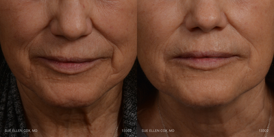 Dermal Fillers before and after photo