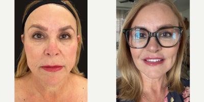 before and after image