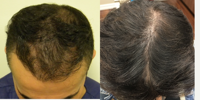 PRP for Hair Loss before and after photo