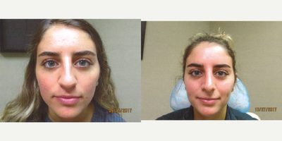 Rhinoplasty before and after photo