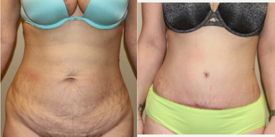 Tummy Tuck before and after photo